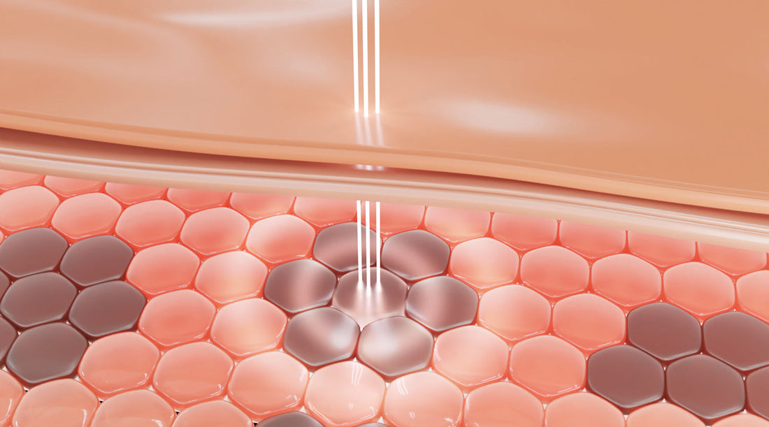 melasma IPL Singapore