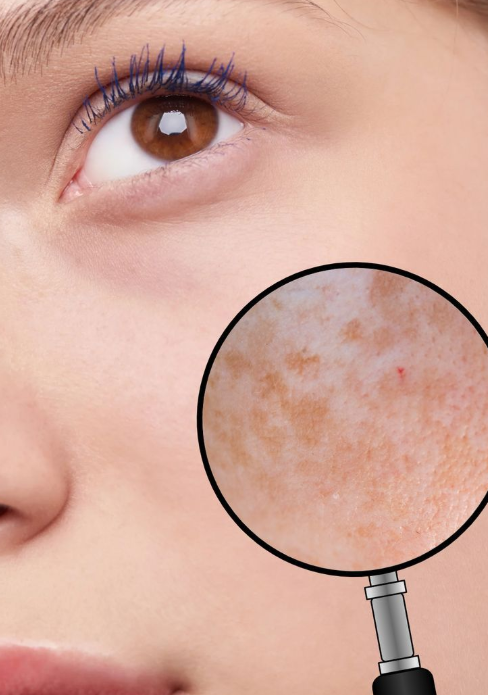 Preventing Melasma Rebound and Supporting Post-Procedure Recovery with Recombinant Human Collagen