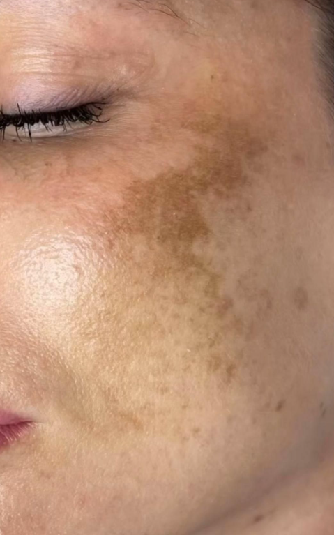 recombinant collagen melasma treatment