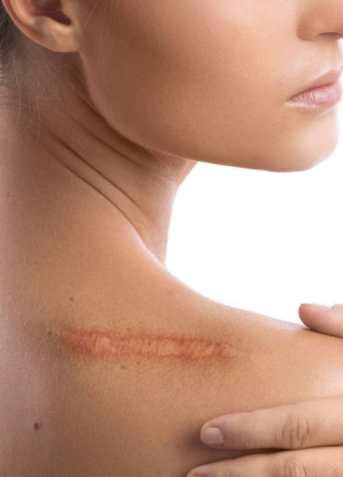 scar gel for surgery