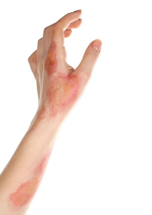 Biocompatible Collagen Therapy in Burns: Faster Healing with Topical Homologous Human Collagen
